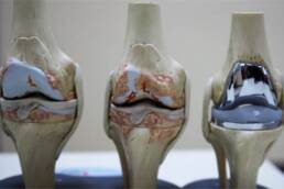 Joint-Replacement